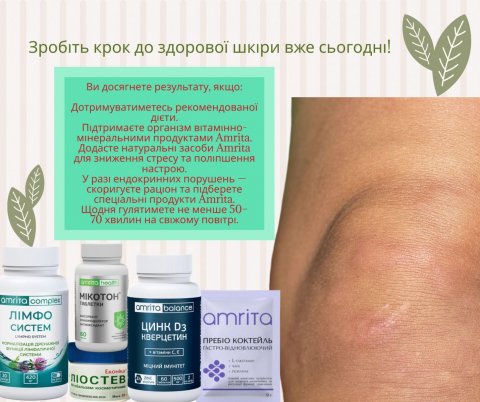 Поради при себорейному дерматиті від Amrita